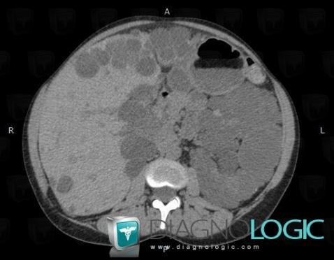 Polycystic kidney disease, Kidney, CT