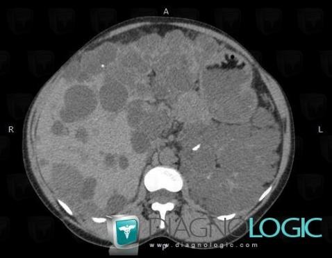 Polycystic kidney disease, Kidney, CT