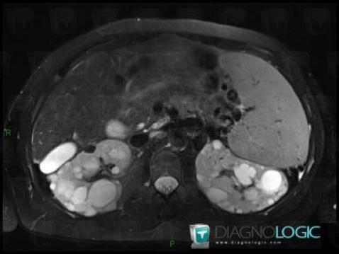 Polycystic kidney disease, Kidney, MRI