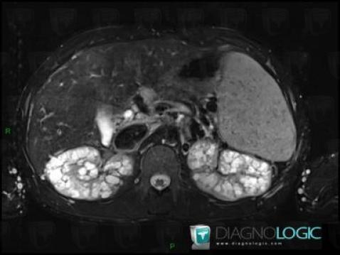 Polycystic kidney disease, Kidney, MRI