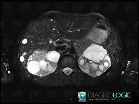 Polycystic kidney disease, Kidney, MRI