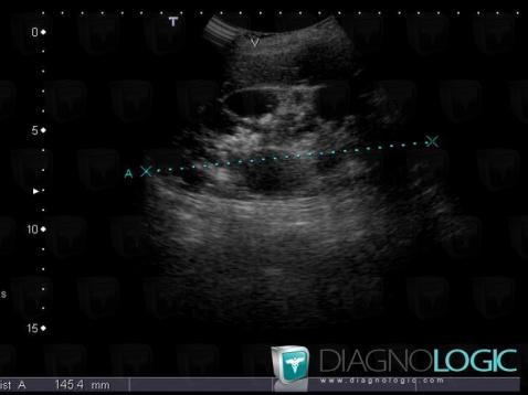 Polycystic kidney disease, Kidney, US