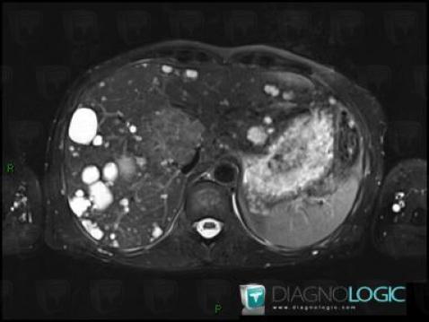 Polycystic kidney disease, Liver, MRI