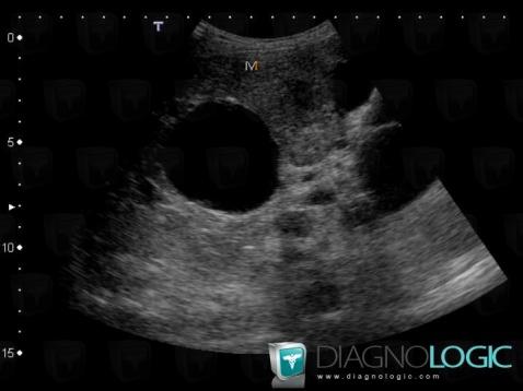 Polycystic kidney disease, Liver, US