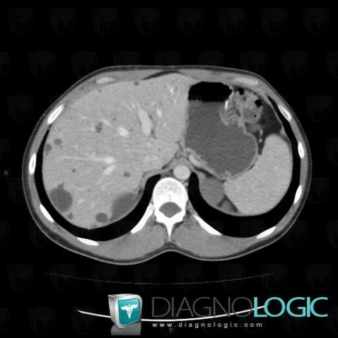 Polycystic liver disease, Liver, CT