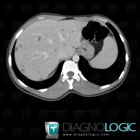 Polycystic liver disease, Liver, CT