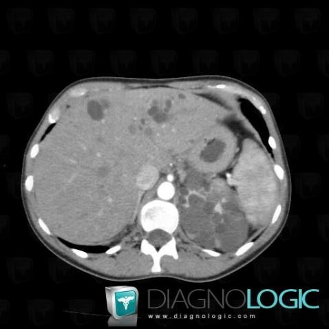 Polycystic liver disease, Liver, CT