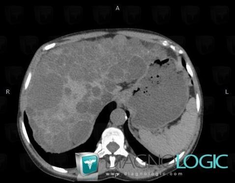 Polycystic liver disease, Liver, CT