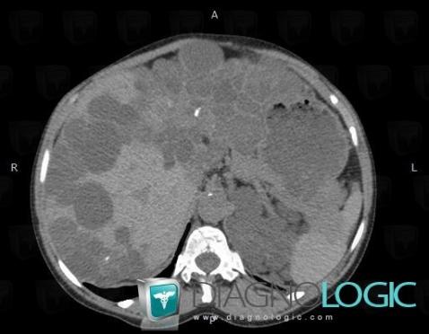 Polycystic liver disease, Liver, CT