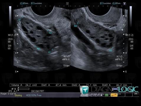 Polycystic ovarian disease, Adnexa / Ovary fallopian tube, US