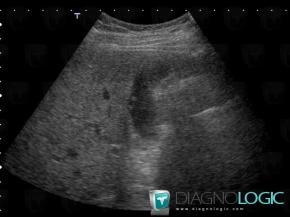 Polyp, Gallbladder, US