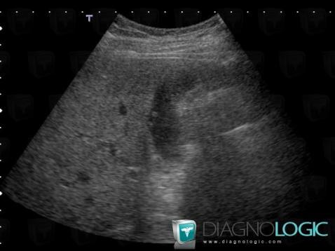 Polyp, Gallbladder, US