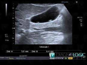 Polyp, Gallbladder, US