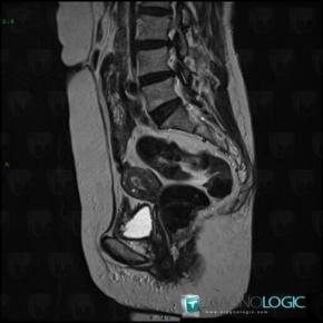 Polyp, Uterus, MRI