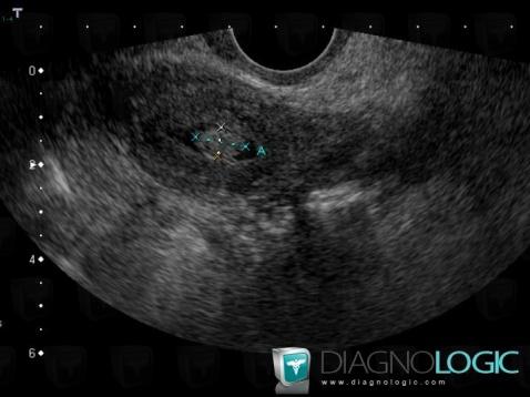 Polyp, Uterus, US
