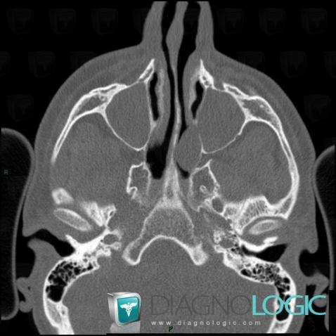 Polype antrochoanal, Fosses nasales / Nasopharynx, Scanner