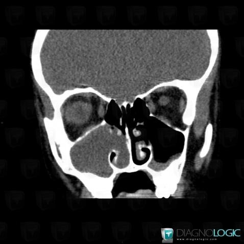 Polype antrochoanal, Fosses nasales / Nasopharynx, Scanner