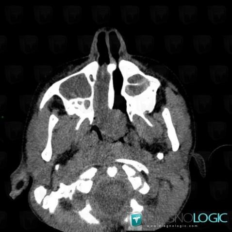 Polype antrochoanal, Fosses nasales / Nasopharynx, Scanner