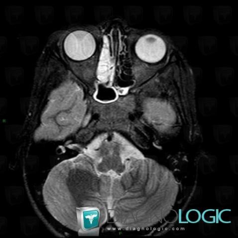 Nasal Polyp Mri Radiopaedia