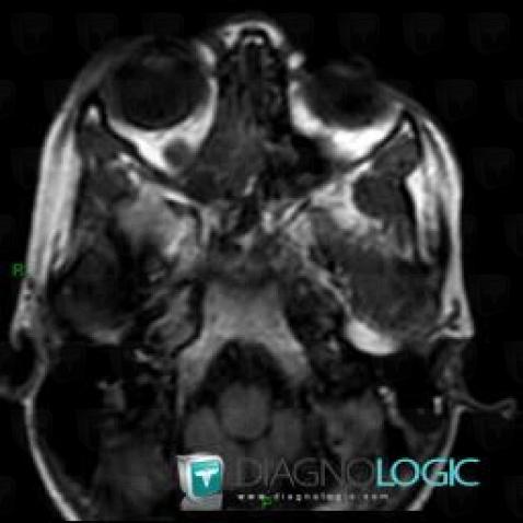 Nasal Polyp Mri Radiopaedia