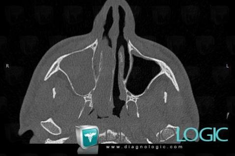 Polype antrochoanal, Fosses nasales / Nasopharynx, TDM