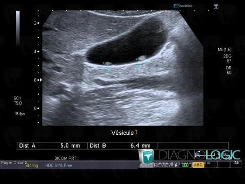 Polype, Vésicule biliaire, Echographie