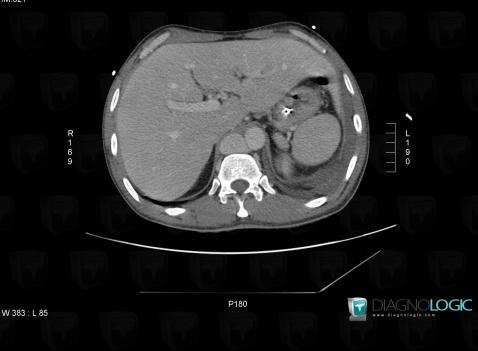 Polysplenia, Spleen, CT