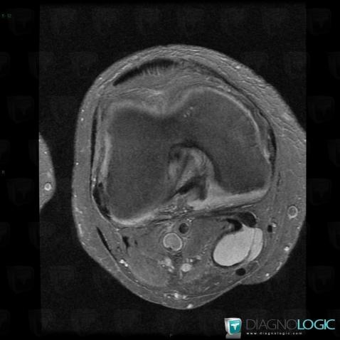 Popliteal cyst, Femorotibial joints - Intercondylar notch, Other soft tissues/nerves - Knee, MRI