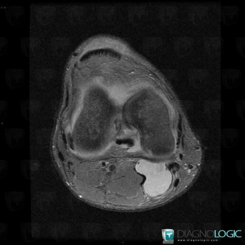 Popliteal cyst, Other soft tissues/nerves - Knee, MRI