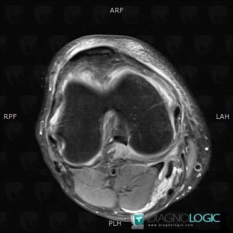 Popliteal cyst, Other soft tissues/nerves - Knee, MRI