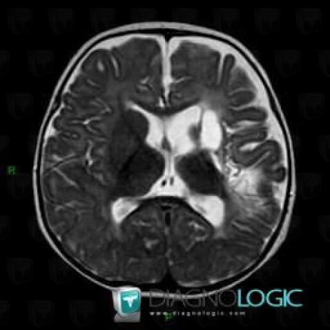 Porencephalic cyst, Cerebral hemispheres, MRI