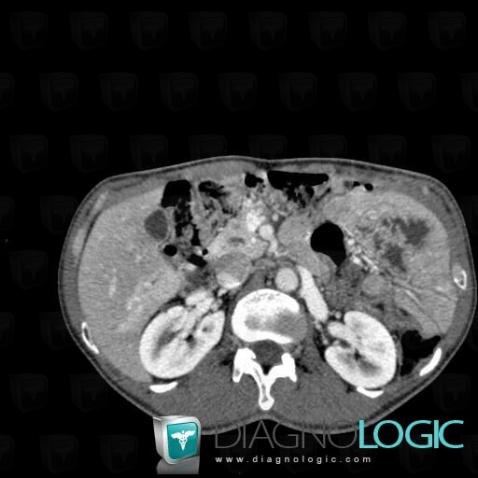 Portal vein thrombosis, Liver, CT