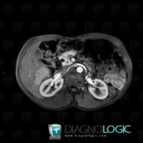 Portal vein thrombosis, Liver, MRI