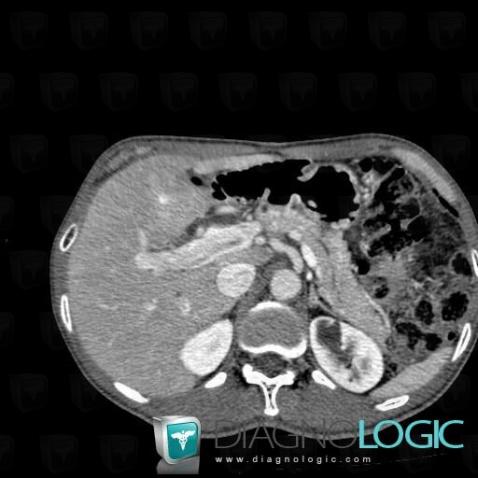 Portal vein thrombosis, Portal vein and branches, CT