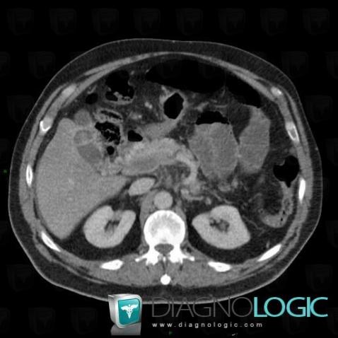 Portal vein thrombosis, Portal vein and branches, CT