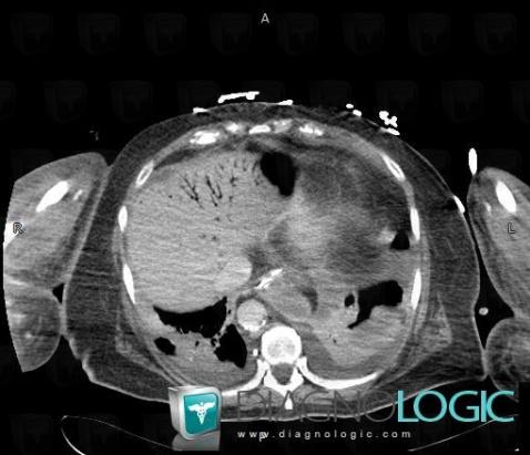 Portal venous gas, Liver, Portal vein and branches, CT