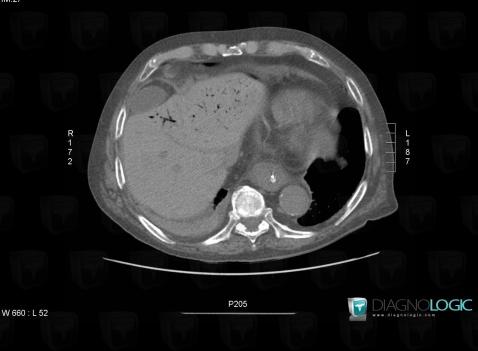 Portal venous gas, Liver, Portal vein and branches, CT