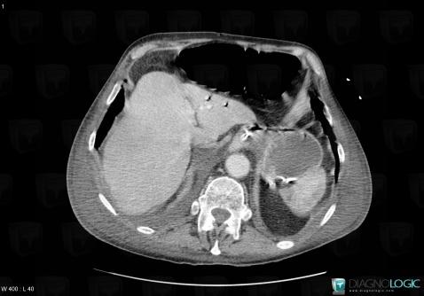 Portal venous gas, Liver, Portal vein and branches, CT