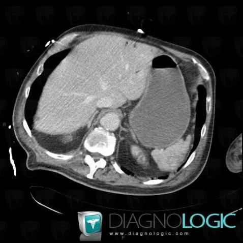 Portal venous gas, Liver, Portal vein and branches, CT