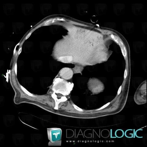 Radiology case : Mesenteric ischemia (CT) - Diagnologic