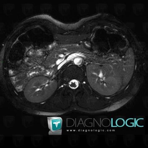 Porto caval fistula, Inferior vena cava, Portal vein and branches, MRI