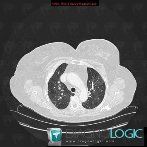 Post embolic chronic pulmonary heart disease, Pulmonary parenchyma, CT
