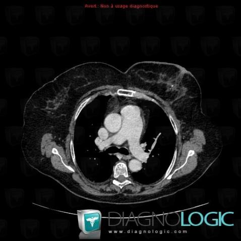 Post embolic chronic pulmonary heart disease, Pulmonary parenchyma, CT