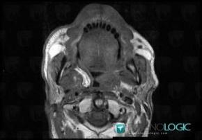 Post operative, Deep facial spaces, MRI