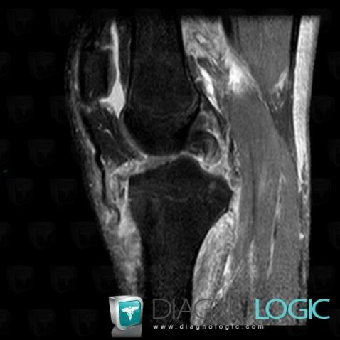 Posterior cruciate ligament rupture, Posterior cruciate ligament, MRI