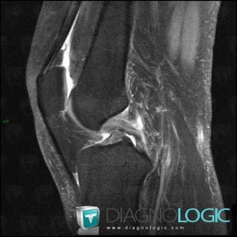 Posterior cruciate ligament rupture, Posterior cruciate ligament, MRI