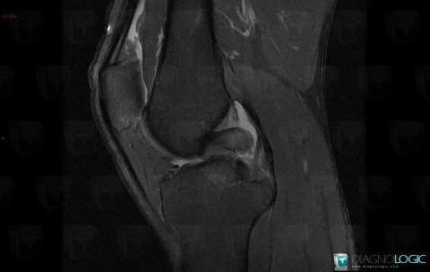 Posterior cruciate ligament rupture, Posterior cruciate ligament, MRI