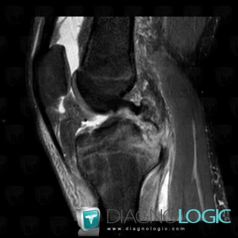 Posterior cruciate ligament rupture, Posterior cruciate ligament, MRI