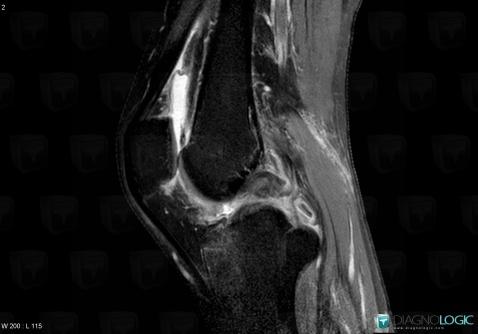 Posterior cruciate ligament rupture, Posterior cruciate ligament, MRI