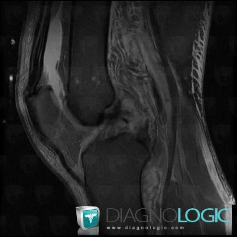 Posterior cruciate ligament rupture, Posterior cruciate ligament, MRI